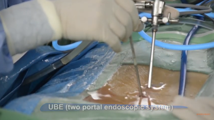 UBE/BIPOTAL Spine Surgery Procedure