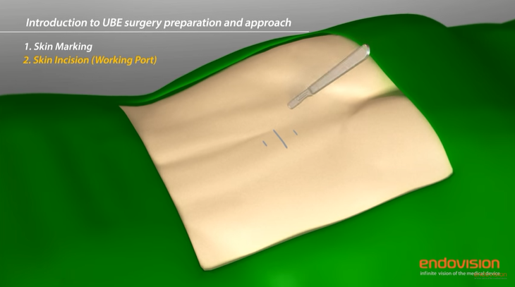 UBE 양방향 척추 내시경술 애니메이션